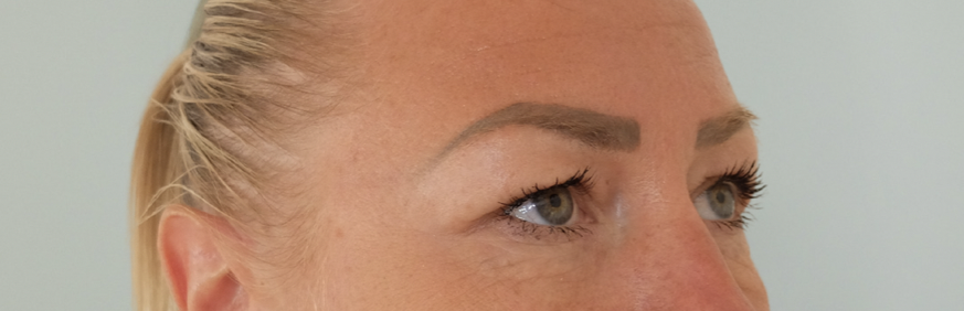 Blépharoplastie avant après