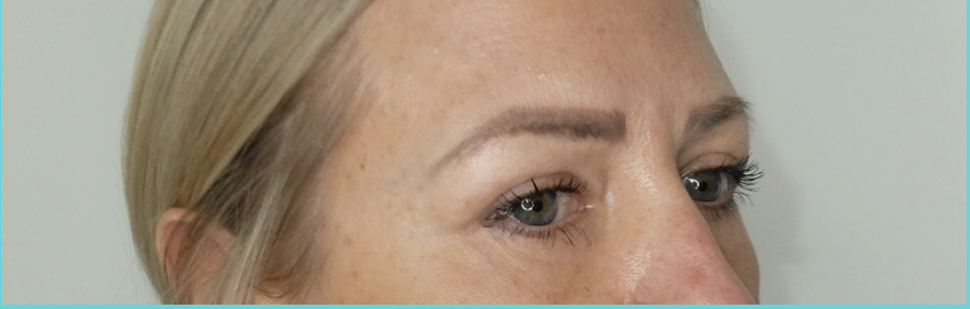 blépharoplastie lausanne