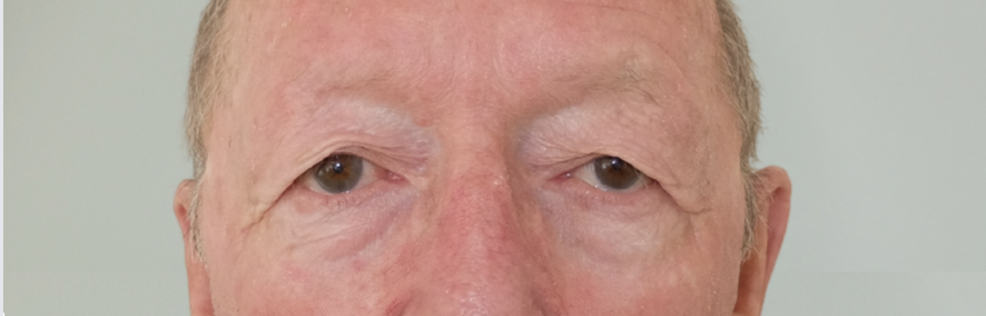 blépharoplastie