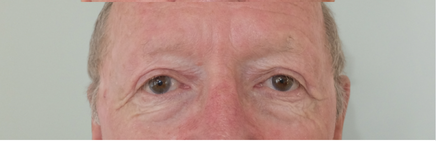 blépharoplastie résultat