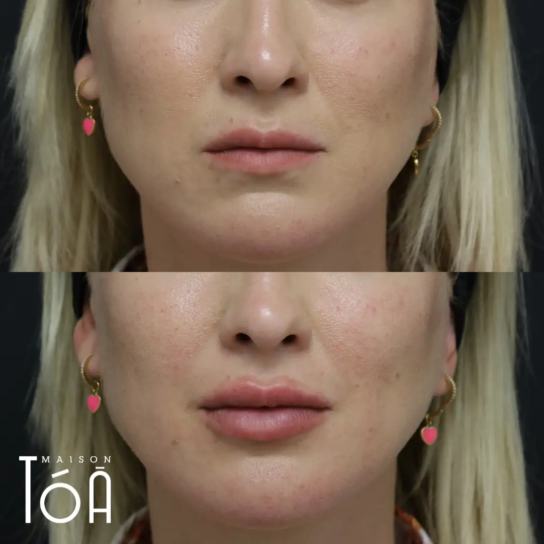 acide hyaluronique lèvres