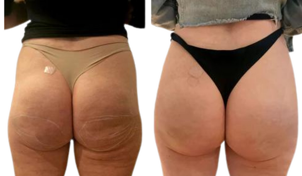 acide hyaluronique fesses