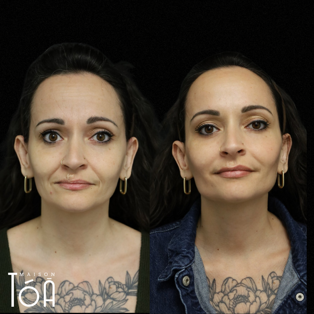 Sculptra avant après