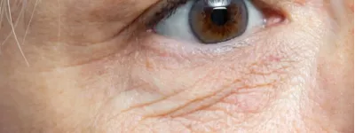 rides sous les yeux injections