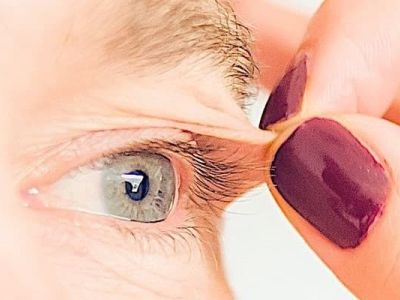 Blépharoplastie Lausanne