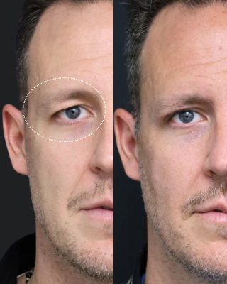 Avant Après Blépharoplastie